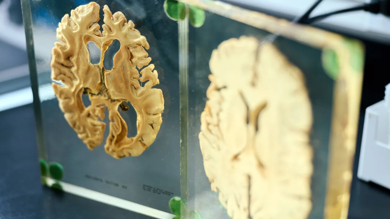 Dos cortes transversales de cerebro humano fijados en bloques de acrílico transparente sobre una mesa de laboratorio.