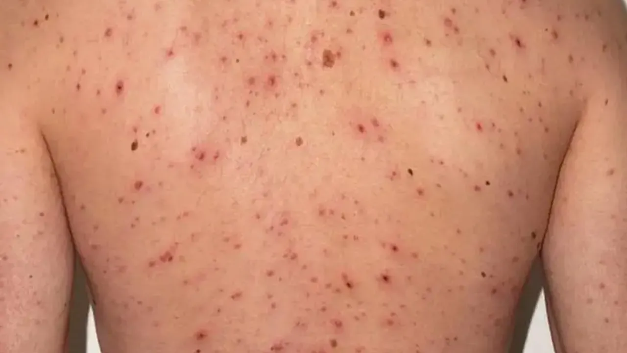 Espalda de una persona joven repleta de erupciones y manchas rojas causadas por una infección cutánea o viral.