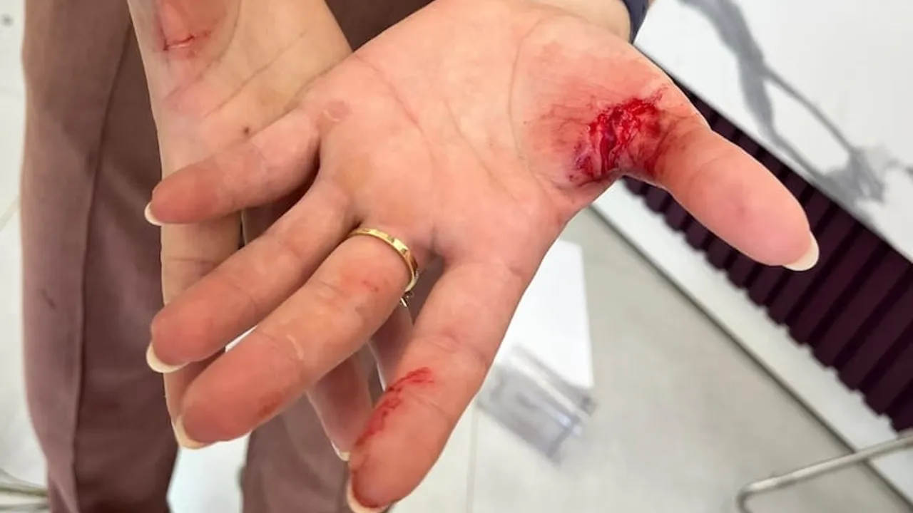 Manos abiertas con notorias heridas y manchas de sangre causadas por un arma blanca cortante.