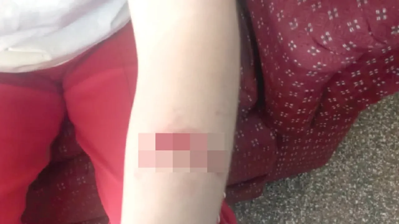 Brazo de una persona con una zona pixelada que cubre una herida cortante sobre un sillón bordó.